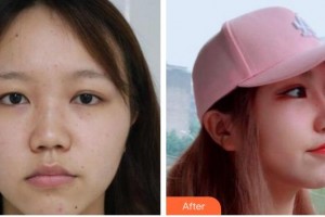 台州昊阳医疗美容医院王文波整形价格表附鼻部综合案例展示