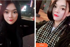 台州拜博口腔医院丁大伟整形价格表附牙齿隐形矫正案例展示