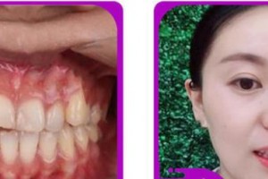 台州牙博士口腔门诊部黄翔宇整形价格表附牙齿隐形矫正案例展示