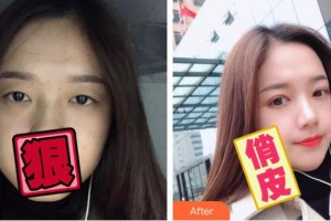 台州国际眼科医院姜俭整形价格表附切开双眼皮案例展示
