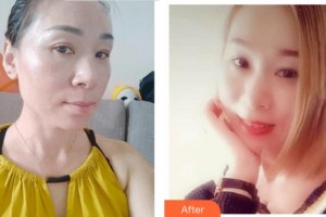 四川华美紫馨医学美容医院赵琼英整形价格表附激光祛斑案例展示
