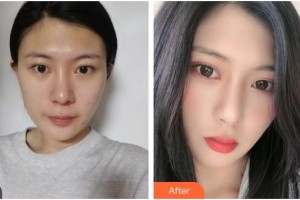 广元美华医学美容诊所王见平整形价格表附眼部综合案例展示