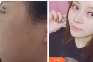 内江瑞美医疗美容门诊部金承俊整形价格表附眼部综合案例展示