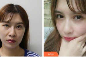 眉山眼耳鼻咽喉专科医院庄代江整形价格表附切开双眼皮案例展示