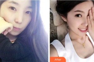 雅安鑫西华口腔整形医院周颖整形价格表附牙齿隐形矫正案例展示