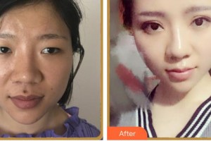 湖南黄兴医院整形美容中心李教授整形价格表附眼部综合案例展示