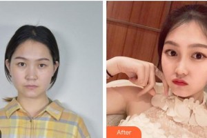 湖南韩美医疗美容门诊部刘荣华整形价格表附眼部综合案例展示