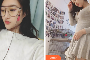汕头曙光整形美容医院娄润文整形价格表附微脂丰胸案例展示