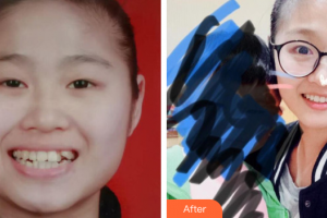 汕头名流整形美容医院麻维达整形价格表附金属托槽案例展示