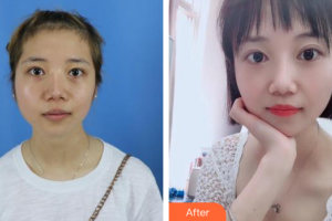 汕头大学医学院第一附属医院医学美容中心蔡湘娜整形价格表附激光祛斑案例展示