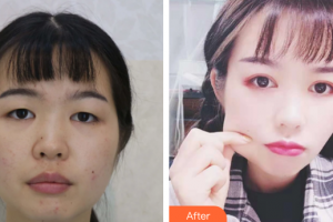 汕头华美医疗美容医院何斌整形价格表附切开双眼皮案例展示