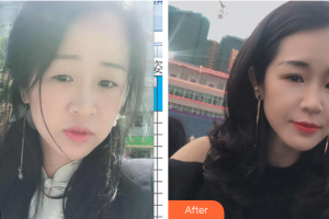 汕头华美医疗美容医院朱洙玉整形价格表附切开双眼皮案例展示