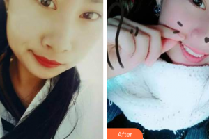 汕头华美医疗美容医院杨斌整形价格表附超声波洗牙案例展示