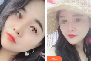 汕头大学医学院第二附属医院烧伤整形科杨旅军整形价格表附超微小气泡案例展示