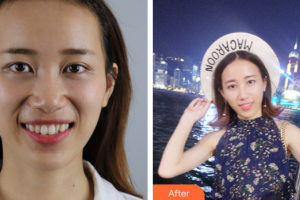 汕头邱宁口腔诊所许瑞芬整形价格表附全隐形牙齿矫正案例展示