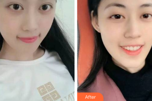 汕头邱宁口腔诊所邱宁整形价格表附瓷贴面案例展示