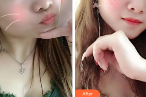 佛山亚韩整形美容门诊部时安平整形价格表附红蓝光祛痘案例展示