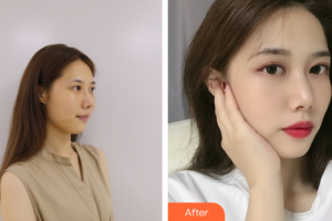 佛山曙光金子医学美容医院郑永健整形价格表附玻尿酸精华导入案例展示