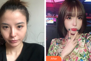 佛山曙光金子医学美容医院刘洲尉整形价格表附面部吸脂案例展示