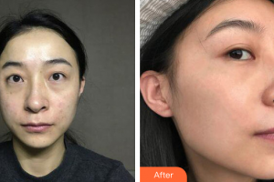 佛山南海区第二人民医院烧伤整形科陆显斌整形价格表附激光美肤激光祛斑案例展示