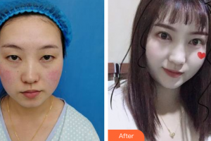 佛山广美医疗美容门诊部王文整形价格表附眼部手术案例展示