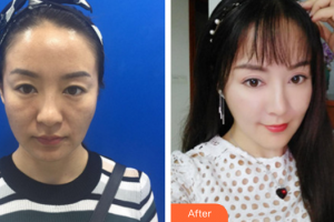 佛山贝尔美医学美容整形医院陈海燕整形价格表附埋线提升案例展示