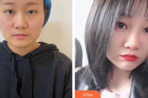 佛山美嘉美医疗美容门诊部朴善在整形价格表附埋线双眼皮案例展示