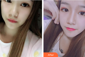 佛山贝尔美医学美容整形医院李晟源整形价格表附鼻部整形案例展示