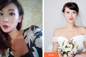 佛山广美医疗美容门诊部罗雄鹏整形价格表附鼻部手术案例展示