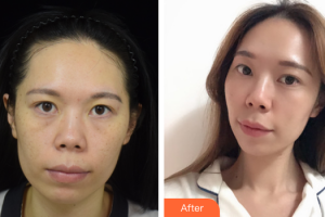 佛山广美医疗美容门诊部杨群凤整形价格表附热拉提紧致除皱案例展示