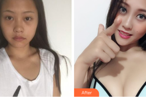 佛山华美整形美容医院陈听柿整形价格表附假体隆胸案例展示