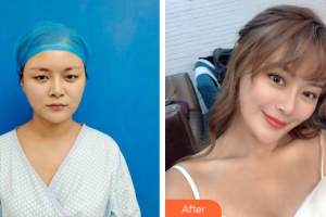 佛山东康整形美容门诊部何镇宇整形价格表附五维锚定眼部手术案例展示