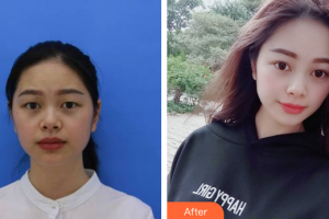 佛山美莱医疗美容医院刘永扬整形价格表附眼部整形案例展示