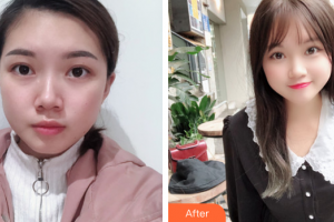 佛山广大壹美医疗美容门诊部曹壁浪整形价格表附双眼皮案例展示