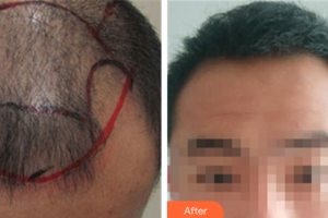 佛山广大壹美医疗美容门诊部应晓红整形价格表附种植发际线案例展示