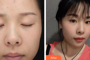 佛山华厦眼科医院徐莉整形价格表附美白嫩肤NIR牛奶光案例展示