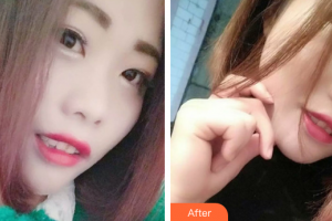 佛山南海中大口腔医院吴成坤整形价格表附超声波洗牙案例展示