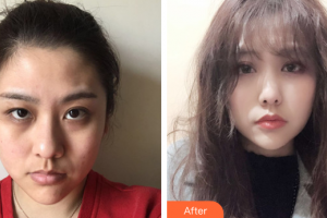 江门玛丽整形医院翁明飞整形价格表附激光去眼袋案例展示