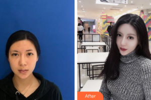 江门西区医院中医美容中心巫云整形价格表附热玛吉抗衰案例展示