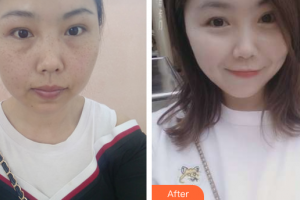 江门福康医学整形美容医院李嘉欣整形价格表附祛雀斑案例展示