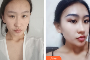 江门福康医学整形美容医院付洪波整形价格表附眼部手术案例展示