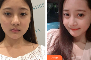 湛江华美整形美容医院王军整形价格表附热玛吉案例展示