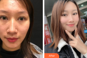 湛江澳泰整形美容医院曾兆舜整形价格表附去痘印痘坑案例展示