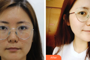 湛江华美整形美容医院汪峰整形价格表附面部吸脂案例展示