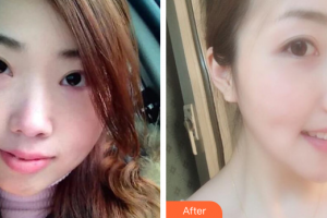 湛江澳泰整形美容医院陈突整形价格表附金属矫正案例展示
