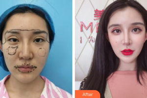 湛江澳泰整形美容医院严钟娴整形价格表附埋线提升案例展示