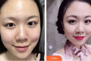 湛江华美整形美容医院颜忠莲整形价格表附激光美肤激光祛斑案例展示