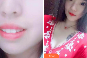 湛江南方口腔医院吴晓程整形价格表附时代天使矫正案例展示