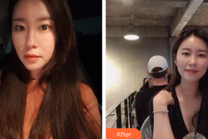 肇庆华美整形美容医院涂成芳整形价格表附激光祛痘案例展示