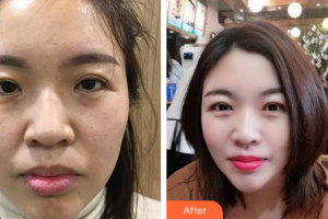 肇庆市皮肤病医院医疗美容科莫家亮整形价格表附光子嫩肤案例展示